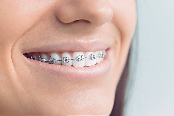 Best Veneers and Lumineers  in Hartford City, IN